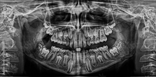 Panoramic X-ray scan of humans teeth
