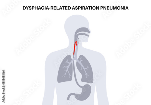 Aspiration pneumonia poster