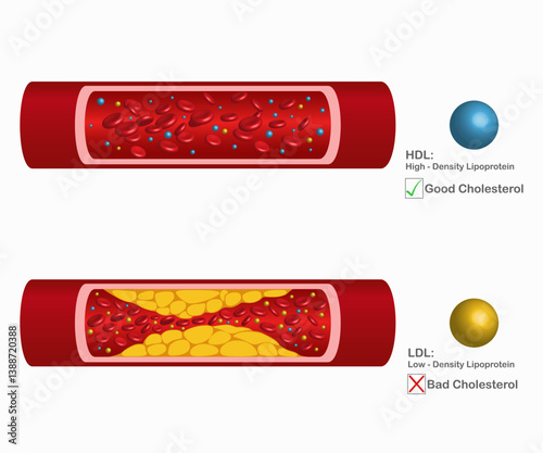 Arteries that are clogged with fat that causes blood clots are a leading cause of death. Types of cholesterol. High-density lipoprotein (HDL) and low-density lipoprotein (LDL). Vector illustration.