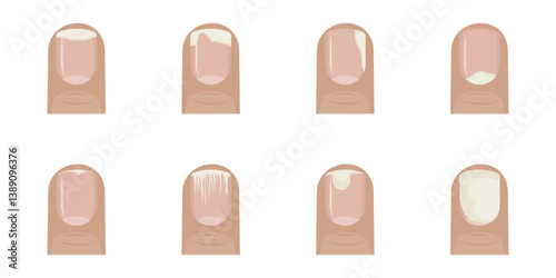 Different types of onychosis affecting fingernails are shown in medical illustration
