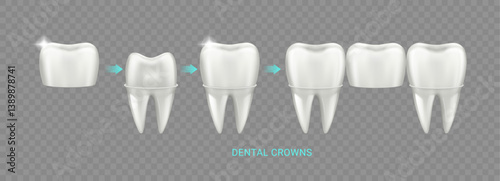 Dental crowns and dentures. Vector realistic embedding supported bridge, artificial tooth joined to adjacent endodontist implants. Fixed orthodontal prosthesis. Stomatology and orthodontic help