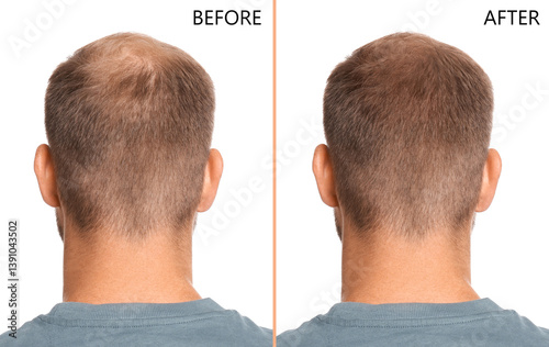 Obraz na płótnie Man suffering from baldness on white background, back view. Collage with photos before and after treatment w salonie