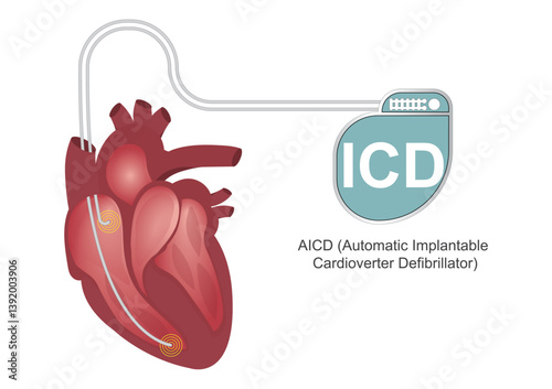 An automated implantable cardioverter defibrillator.
