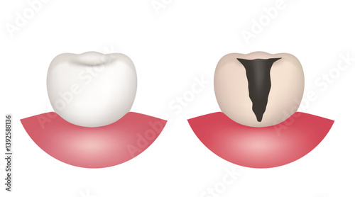 Healthy tooth and carious tooth. Vector 3d clipart isolated on white background.