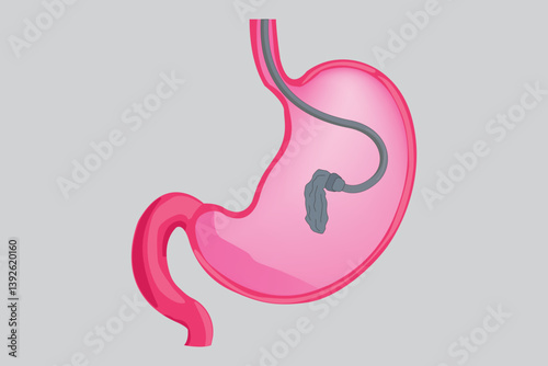 medical illustration. Gastric balloon illustration inside stomach for weight loss and bariatric procedure concept