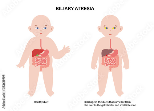 Biliary atresia disease