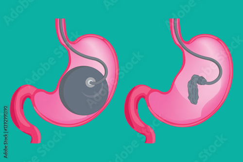 medical illustration. Gastric balloon illustration inside stomach for weight loss and bariatric procedure concept. eps 10