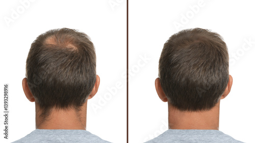 Принти на полотні Man suffering from baldness on white background, back view