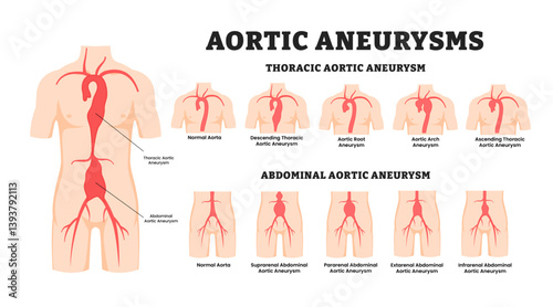Different types of aortic aneurysm types, educational medical poster design infographic, labeled thoracic aortic and abdominal aortic aneurysm with various types of aneurysm, swelling in the aorta.