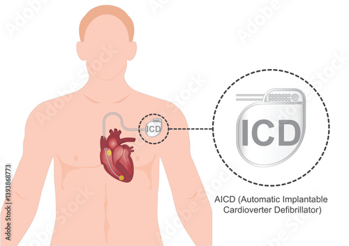 ICD or AICD is an automated implantable cardioverter defibrillator.