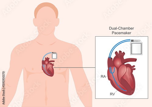 Dual chamber pacemaker.Type of pacemaker.