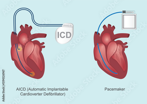 The difference between ICDs and pacemakers.