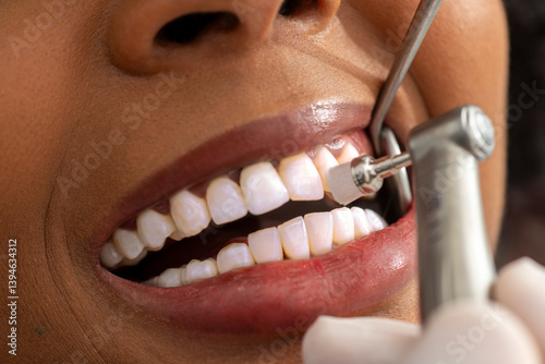 Dentist polishing teeth of patient in dental clinic