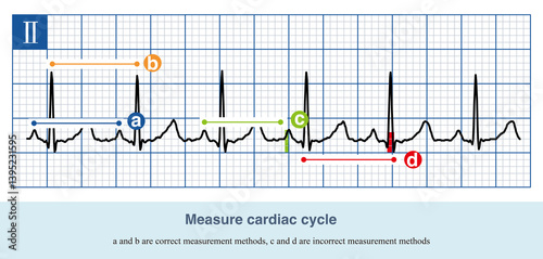 In measuring the cardiac cycle, it is necessary to select the same component of adjacent cardiac waves and the same measurement reference point, such as measuring the PP interval and RR interval.
