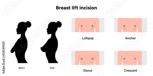 Women’s breast lift incision. Medical female diagram. Before and after