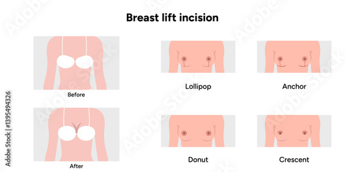 Women’s breast lift incision. Medical female diagram. Before and after