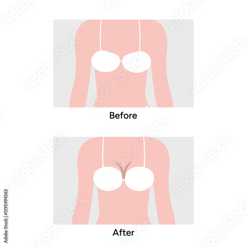 Women’s breast anatomy implant. Medical female diagram. Before and after