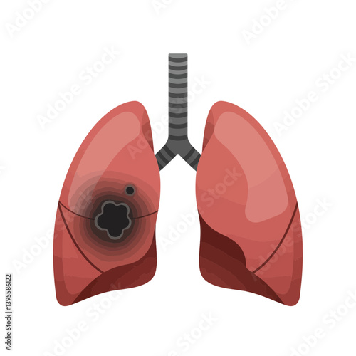 Lung Cancer: A medical illustration revealing the impact of lung cancer on the respiratory system. This image serves as a stark visual reminder of the disease's presence.