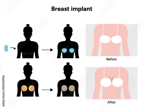 Women’s breast anatomy implant. Medical female diagram. Before and after