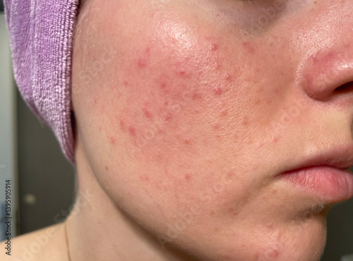 Close-up of a young woman’s face showing acne, clogged pores, and uneven skin texture. Real and unretouched skin captured in natural indoor lighting. photo