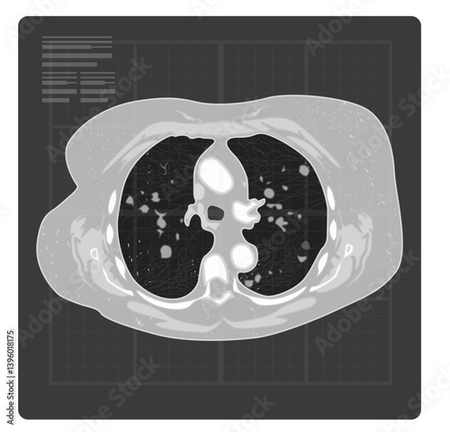 Covid-19 Testing - Human Lungs X-Ray - Illustration
