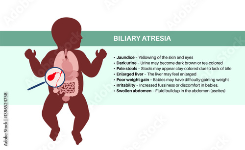 Biliary atresia disease