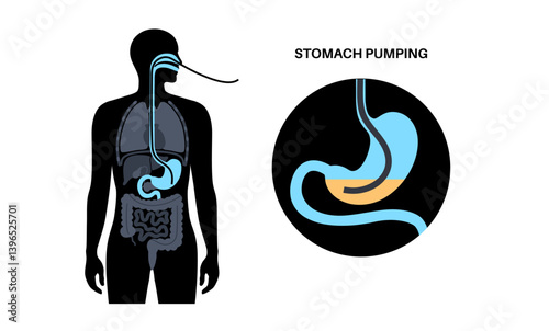 Stomach wash gastric lavage
