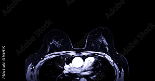 MRI scan of the breasts in an axial view with contrast enhancement.
