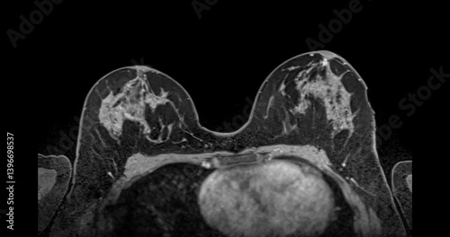 MRI scan of the breasts in an axial view with contrast enhancement.