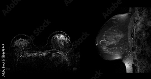 MRI scan of the breasts in an axial and sagittal view with contrast enhancement.