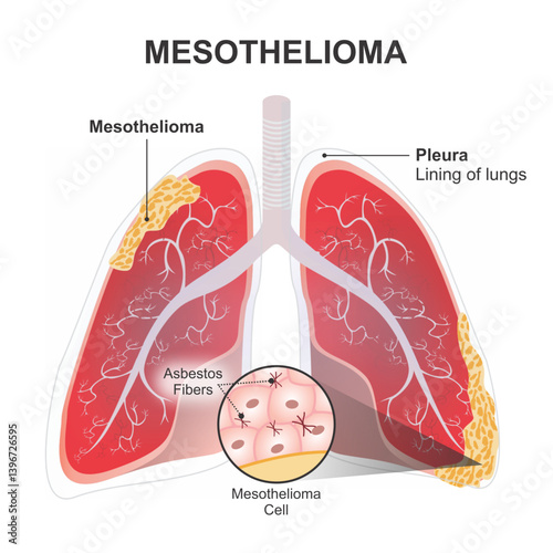 Pleural Mesothelioma Human Lungs Illustration