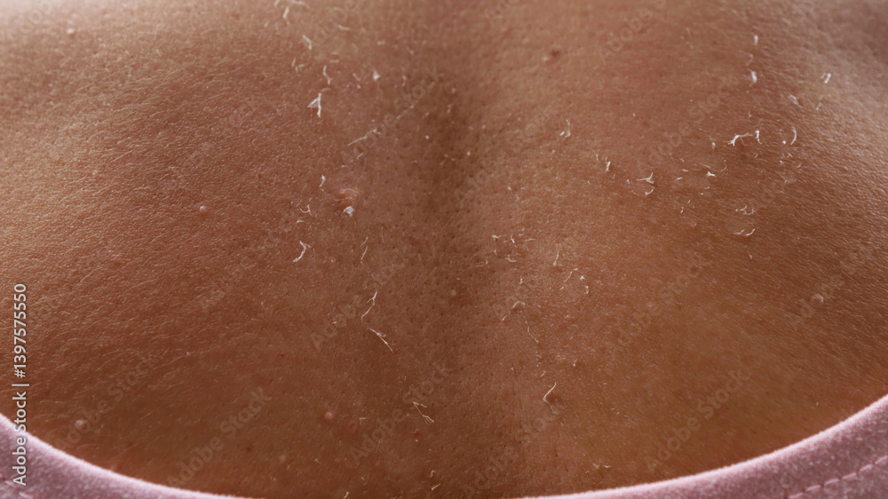 Fototapeta premium Sunburned skin peeling showing healing process after vacation