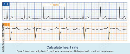 Fotografia When the atrium and ventricle maintain a 1:1 conduction relationship, the atrial rate and ventricular rate are the same, otherwise they need to be evaluated separately