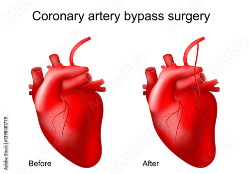 Coronary artery bypass. Bypass grafting. Heart surgery.