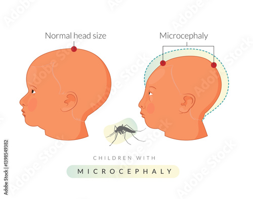 Children with microcephaly - Zika Virus - Stock Illustration