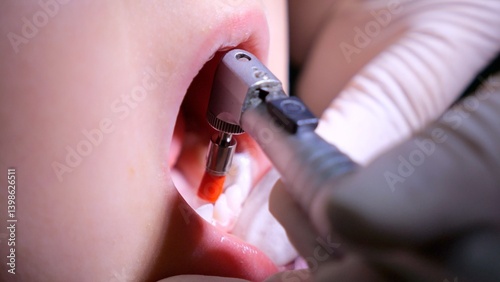 Dental professional applying protective sealant coating to children's molars, creating barrier against decay and preventing bacterial infiltration in tooth grooves
