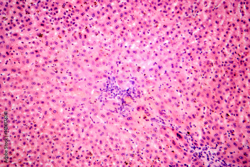 Coccidia in liver, photomicrograph showing intracellular parasitic protozoa causing hepatic coccidiosis with inflammation and hepatocellular damage.