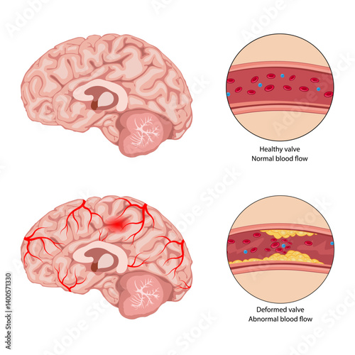 Anatomy of a person with atherosclerotic stroke. Atherosclerosis of the blood vessels of the brain