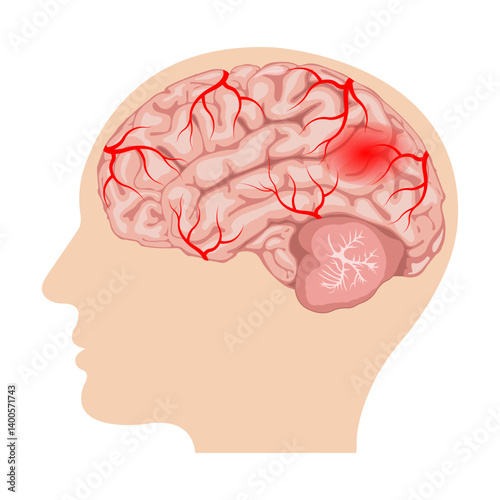 hemorrhagic stroke. intracerebral and subarachnoid hemorrhage. human brain with blood vessels and hematoma