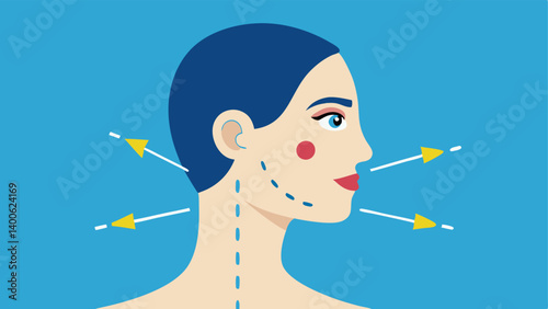 Facial Diagram A side view of a human face with highlighted areas of dermal filler infusion. Arrows indicate where exosomes are injected for rejuvenation.