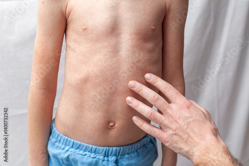 The doctor examines the boy's stomach. The child has a red rash on his stomach from an allergy or scarlet fever.