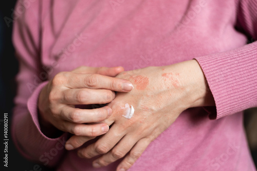 Itching on hands with redness rash. Cause of itchy skin include dermatitis (eczema), dry skin, burned, food,drug allergies, insect bites. Health care concept.