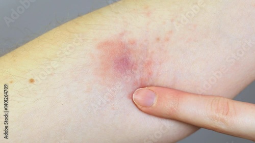 Woman showing  purulent abscess with irritation and dermatitis on hand. Staphylococcus inflammation. Close up, medical video. 4k footage.