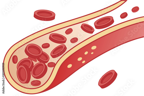 28 Medical illustration, cross-section of blood vessels, red blood cells, cholesterol buildup, arterial plaque, circulatory system, atherosclerosis progression, scientific diagram, detailed anatomy, c