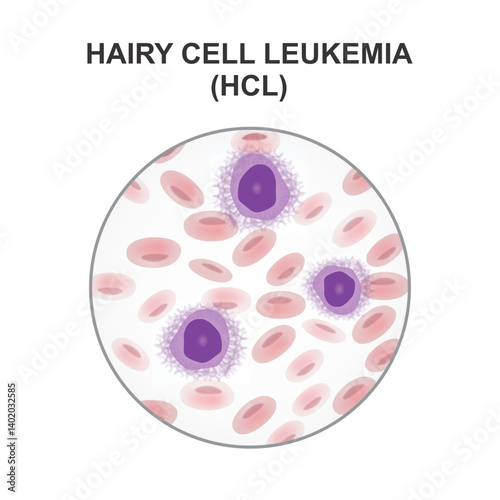 Hairy cell leukemia (HCL) Illustration