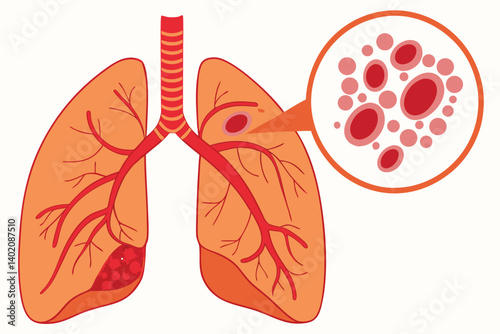 54 Medical illustration, human lungs, microscopic view of blood vessel, cancer cells, 3D rendering, detailed anatomy, orange and red color palette, scientific diagram, cellular structure, medical text