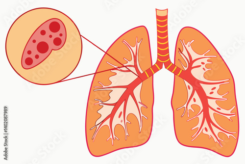 54 Medical illustration, human lungs, microscopic view of blood vessel, cancer cells, 3D rendering, detailed anatomy, orange and red color palette, scientific diagram, cellular structure, medical text
