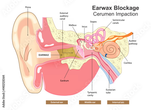 Earwax Blockage Cerumen Impaction Illustration