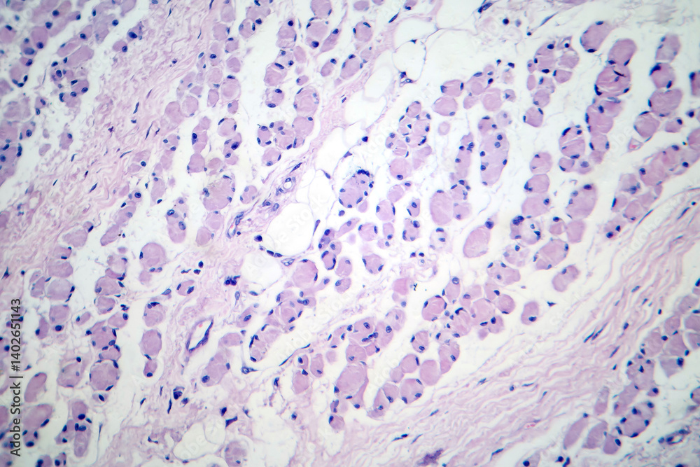 Skeletal muscle atrophy, photomicrograph showing decreased fiber size with increased spacing between them, reduced myofibrils, increased endomysial connective tissue with fatty infiltration