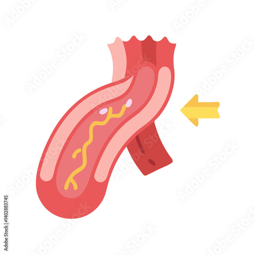 Artery with Blockage Icon Representing Vascular Obstruction and Circulatory Health